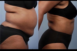 best tumescent-liposuction-surgery in dubai