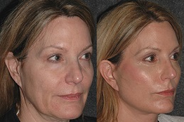 best vector-facelift-cost in dubai
