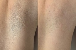 best which-laser-hair-removal-is-best-for-black-skin in dubai