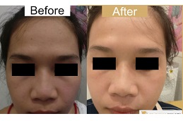 best which-laser-treatment is for glowing-skin in dubai