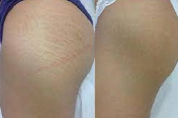 best which-treatment-is-best-for-removing-stretch-marks in dubai