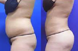 body-jet-liposuction-cost Clinic in Dubai