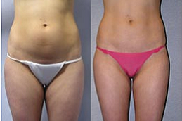 body-jet-liposuction-cost in Abu Dhabi