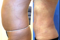body-jet-liposuction-cost in dubai