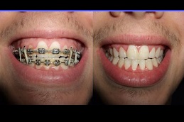 ceramic-braces-cost Clinic in Dubai