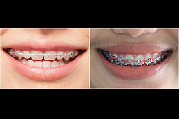 ceramic-braces-cost in Abu Dhabi