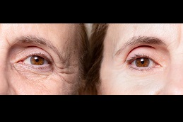 does-botox-work-for-wrinkles-around-the-mouth Clinic in Dubai