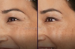 does-botox-work-for-wrinkles-around-the-mouth in Abu Dhabi