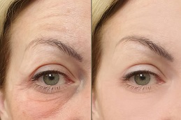  does-botox-work-for-wrinkles-around-the-mouthin-dubai