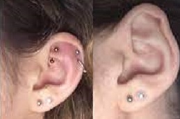 ear-piercing-cost Clinic in Dubai