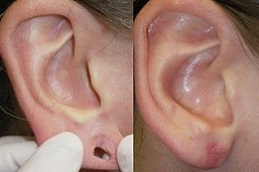 ear-piercing-cost in dubai