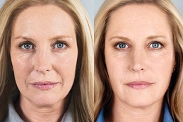 face-lift-without-surgery in Abu Dhabi