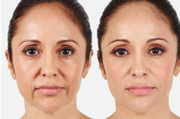 face-lift-without-surgery in dubai