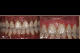 gingivitis-treatment-cost Clinic in Dubai