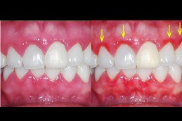 gingivitis-treatment-cost in Abu Dhabi