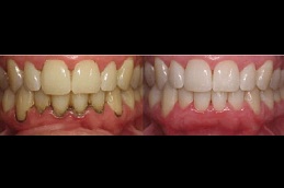 gingivitis-treatment-cost in dubai