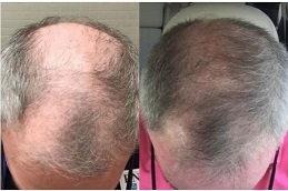 hair-growth-injections Clinic in Dubai