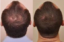 hair-growth-injections in Abu Dhabi