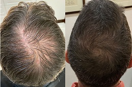 hair-growth-injections in dubai