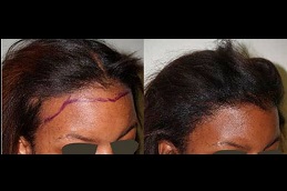 hair-transplant-for-black females Clinic in Dubai