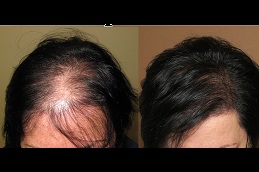hair-transplant-for black females in Abu Dhabi