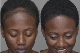 hair-transplant-for-black females in dubai
