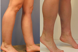 how-much-does-calf-reduction-surgery Clinic in Dubai