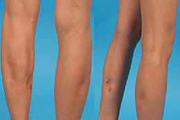 how-much-does-calf-reduction-surgery in Abu Dhabi