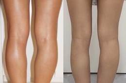 how-much-does-calf-reduction-surgery in dubai