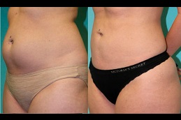 is-liposuction-covered-by-insurance in Abu Dhabi