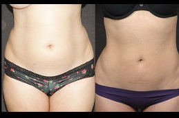 is-liposuction-covered-by-insurance in Dubai