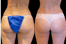 is-liposuction-covered-by-insurance in dubai