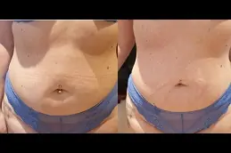 laser-lipolysis-cost in Abu Dhabi