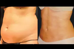 laser-lipolysis-cost in dubai