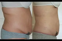 laser-lipolysis-costClinic in Dubai