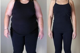 post-weight-loss-cost in dubai