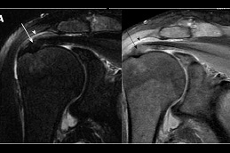 prp-injection-for-rotator-cuff-tear in Abu Dhabi