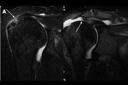 prp injection for rotator cuff tear in dubai
