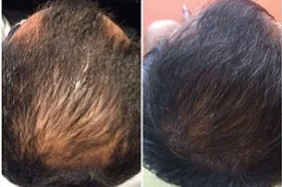 regenera-activa-treatment in dubai
