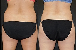 tumescent-liposuction-surgery clinic in Dubai