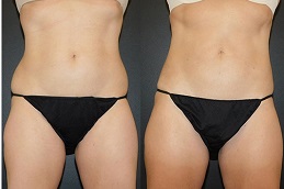 tumescent-liposuction-surgery in Abu Dhabi