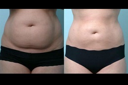 tumescent-liposuction-surgery in dubai