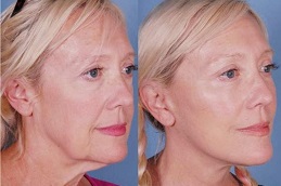 vector-facelift-cost Clinic in Dubai