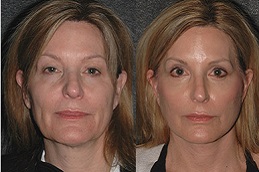 vector-facelift-cost in Abu Dhabi