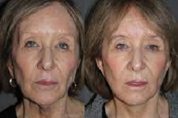 vector-facelift-cost in dubai