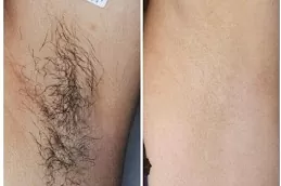 Laser Hair Removal treatment