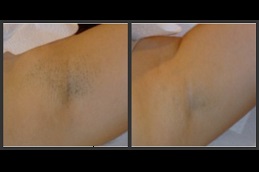 which-laser-hair-removal-is-best-for-black-skin in Abu Dhabi