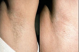 which-laser-hair-removal-is-best-for-black-skin in dubai