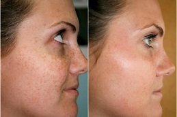 which-laser-treatment-is for glowing-skin Clinic in Dubai