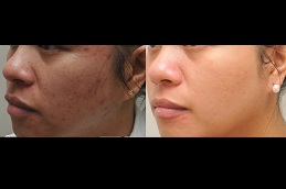 which-laser-treatment-is for glowing-skin in Abu Dhabi